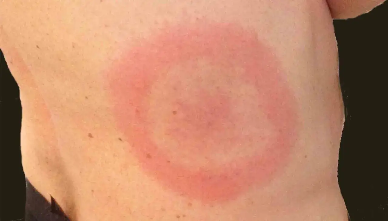 Hud med runda utslag som inte kliar, en rodnad som liknar en ring p&aring; en arm eller rygg.