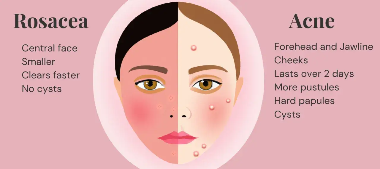 Illustration som visar skillnad mellan rosacea utslag och akne. Rosacea syns i ansiktets mitt, &auml;r mindre och l&auml;ker snabbare.