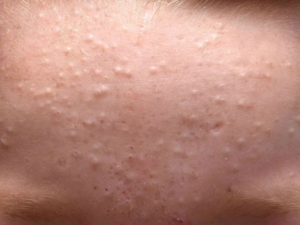 N&auml;rbild p&aring; hud med m&aring;nga sm&aring; vita pormaskar och n&aring;gra m&ouml;rkare prickar. H&aring;ret syns i kanterna.