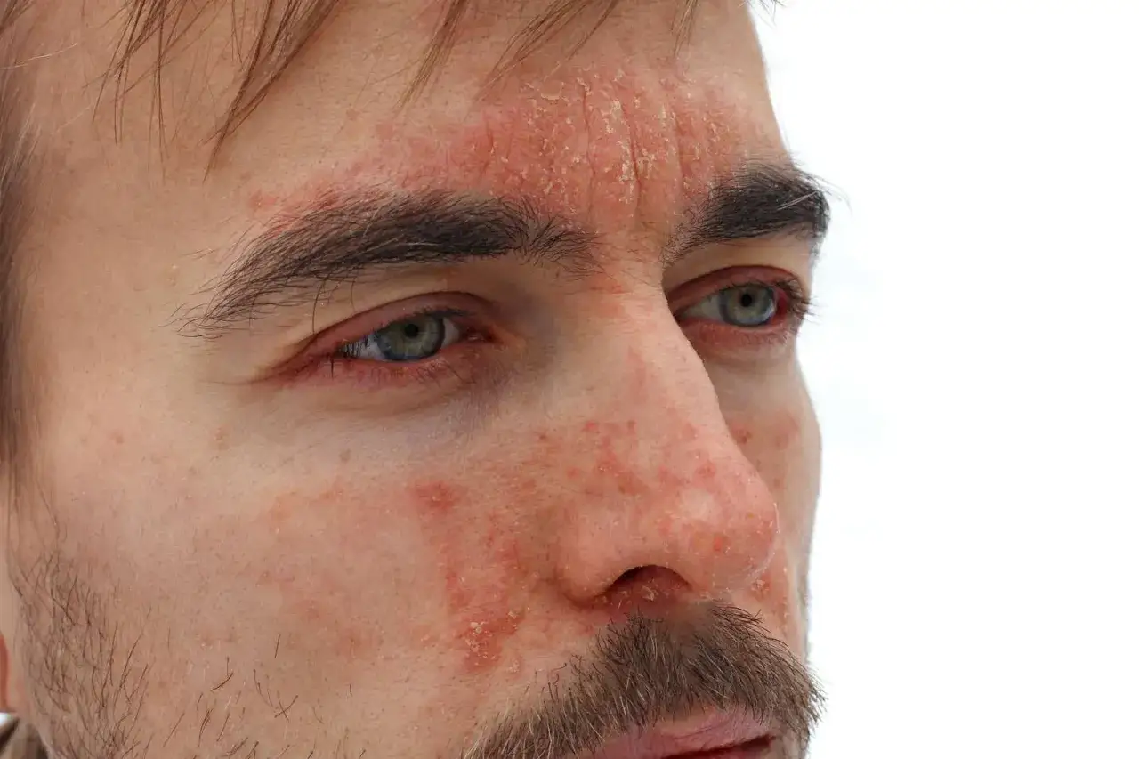 N&auml;rbild p&aring; en mans ansikte med synlig psoriasis i ansiktet, s&auml;rskilt runt &ouml;gonen och p&aring; pannan.