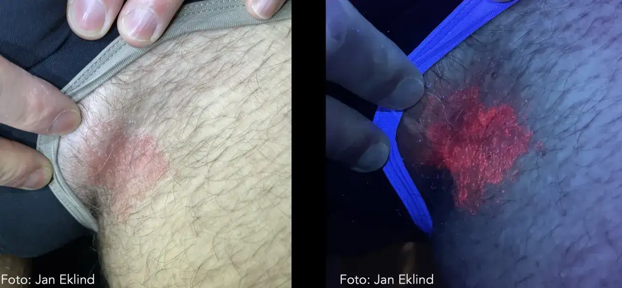 Tv&aring; bilder visar en hudrodnad, den h&ouml;gra bilden &auml;r tagen i UV-ljus d&auml;r rodnaden lyser intensivt r&ouml;tt, vilket indikerar svamp p&aring; huden.