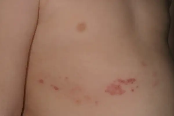 Close-up of a person's torso showing a cluster of small, red, circular rashes on the skin.