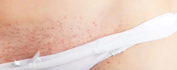 Nära bild på irriterad hud efter rakning, med små röda prickar och knottror.