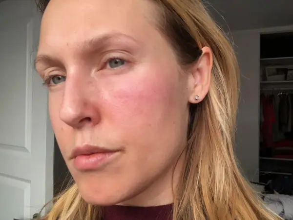Rodnad och utslag på kinden tyder på en allergisk reaktion i huden i ansiktet.