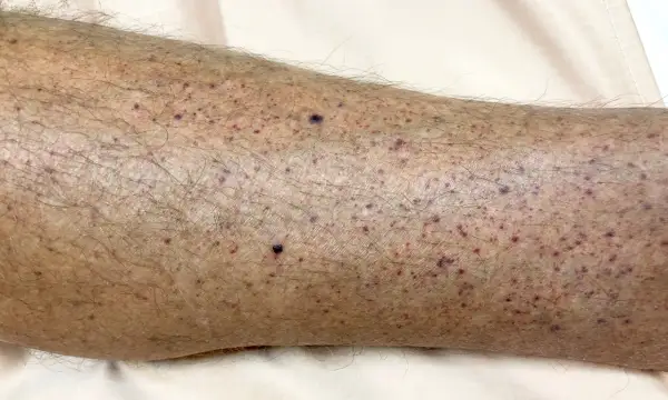 Hud på ett ben med många små lila prickar, tecken på blodbristningar i huden.